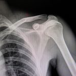 HairlineFracture