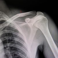 HairlineFracture